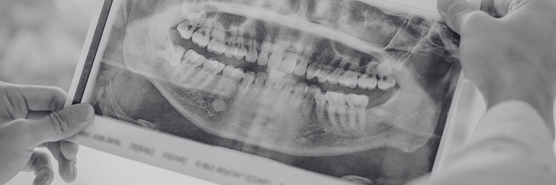 Resin Infiltration | Dentist