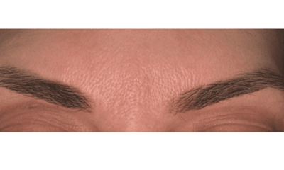 BOTOX-Frown-Lines-After-Image