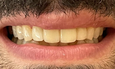 Cosmetic-Porcelain-Crowns-After-Image