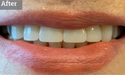 Cosmetic-Porcelain-Crowns-After-Image