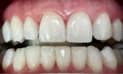 KOR-Whitening-After-Image