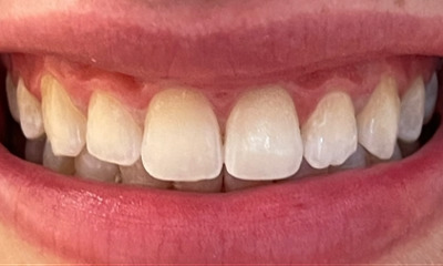 Laser-Whitening-Resin-Infiltration-After-Image