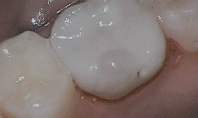 Porcelain-Onlay-CEREC-After-Image