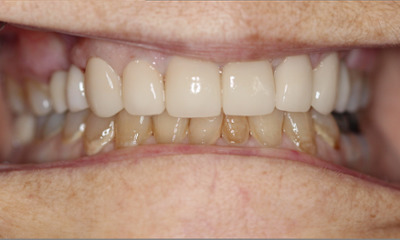 veneer restoration- after photo