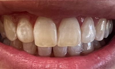 Resin-Infiltration-After-Image