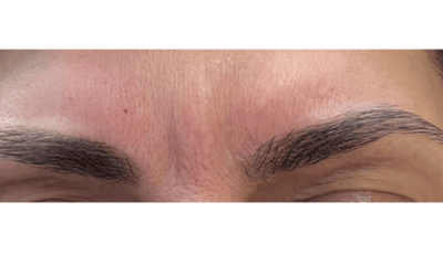 BOTOX-Frown-Lines-Before-Image