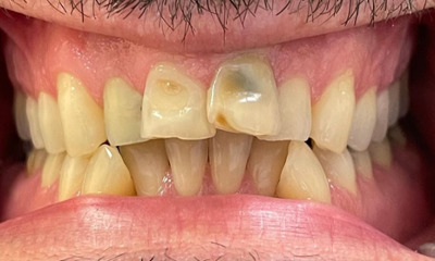 Cosmetic-Porcelain-Crowns-Before-Image