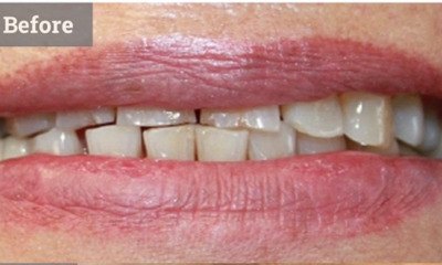 Cosmetic-Porcelain-Crowns-Before-Image