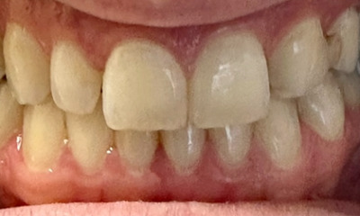 KOR-Whitening-Before-Image