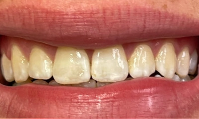 Laser-Whitening-Resin-Infiltration-Before-Image