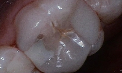 Porcelain-Onlay-CEREC-Before-Image