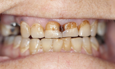 veneer restoration- before photo