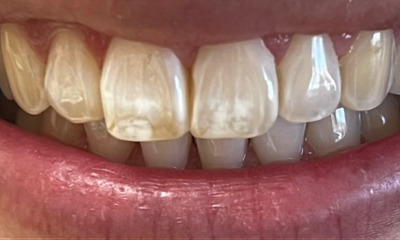 Resin-Infiltration-Before-Image