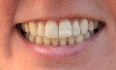 Resin-Infiltration-Before-Image
